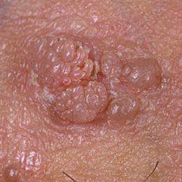 5 Tips Mudah Mengatasi Benjolan Kasar Di Vagina Tanpa Oprasi