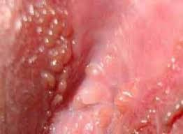 7 Tips Mudah Mengobati Benjolan Kasar Di Penis Terbukti Ampuh