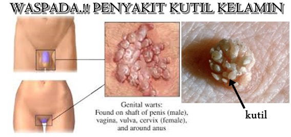 Daftar Harga Obat Benjolan Kasar Di Vagina Paling Manjur
