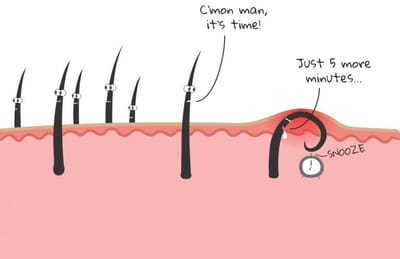 5 Ways To Prevent Ingrown Hairs