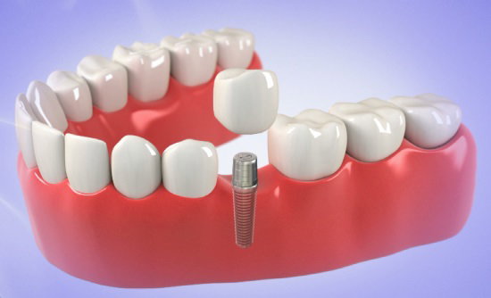 Dental Implants