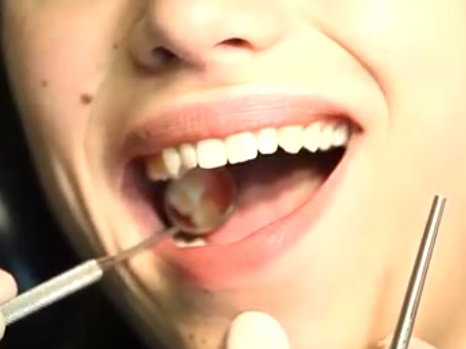 Tooth Extraction
