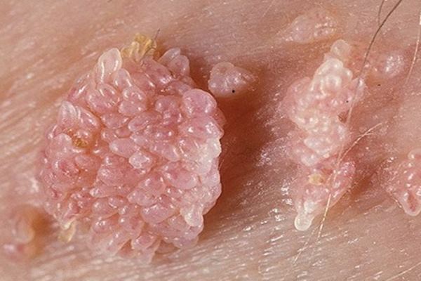 Nama Obat Daging Tumbuh Di Penis  Terbukti Manjur