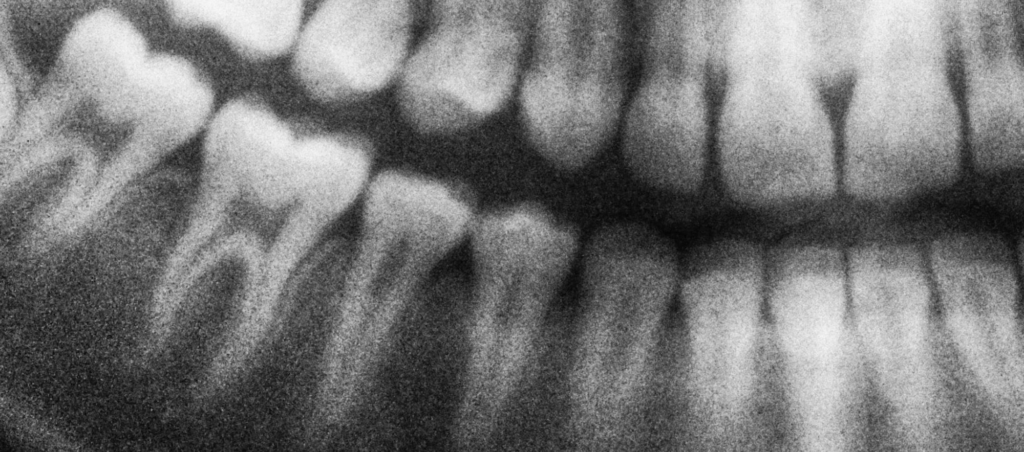 Endodontics / Root Canal Treatment