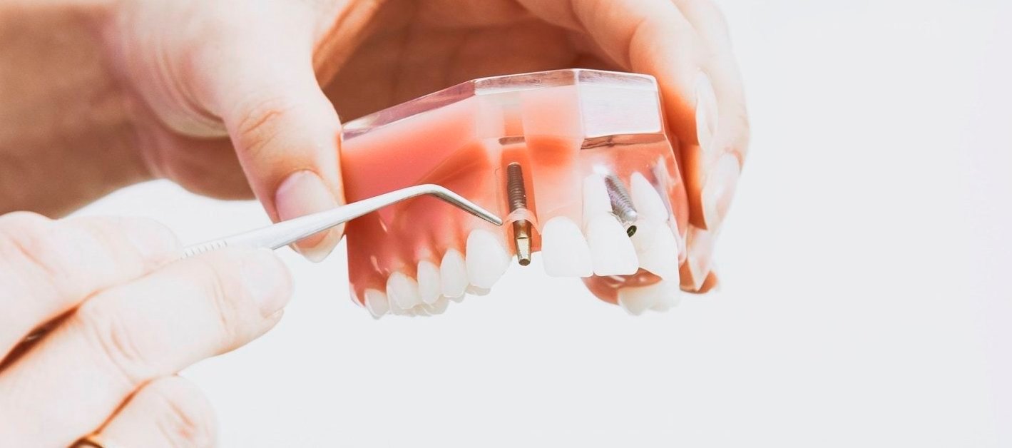 Dental Implants