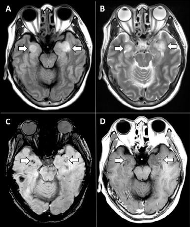 Covid-19 : les symptômes peuvent être neurologiques