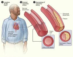 What Baker's research found? (Coronary Heart Disease)