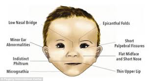 Alcohol Fetal Syndrome