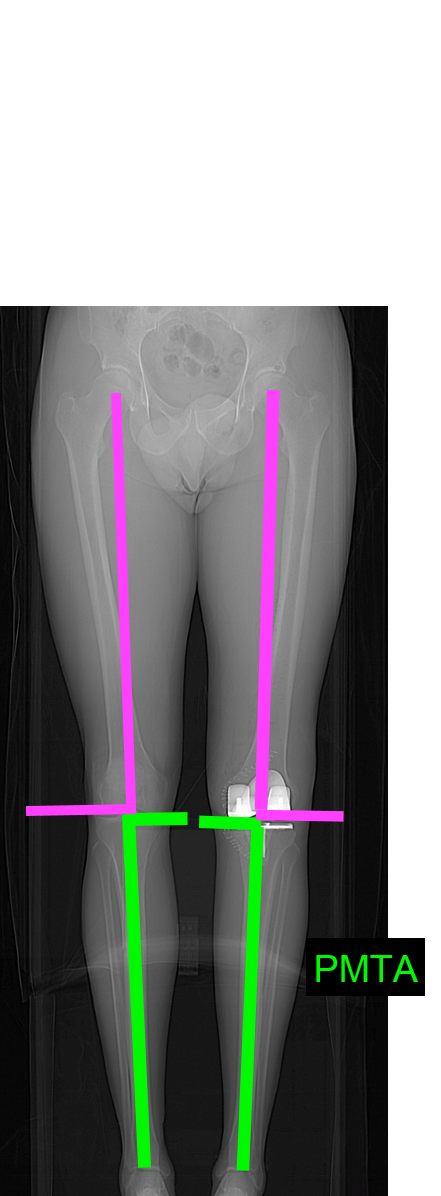 Multi Centric kinematic Alignment  Knee Arthroplasty Symposium