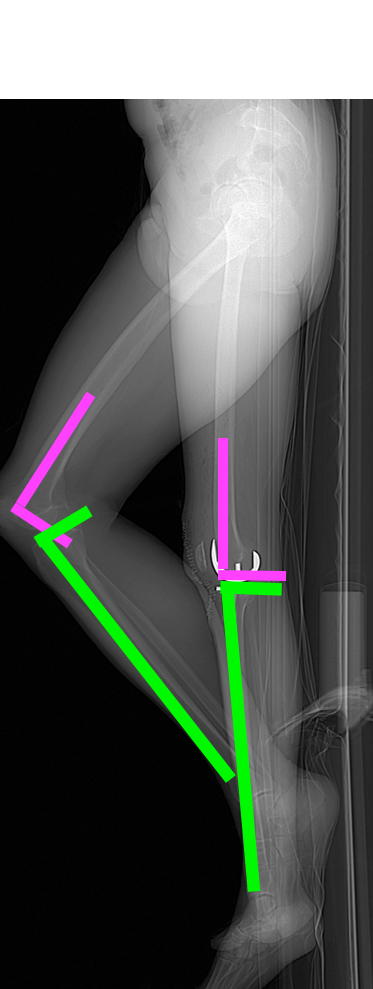 Current Concepts and Controversies around Individualized Knee Surgery