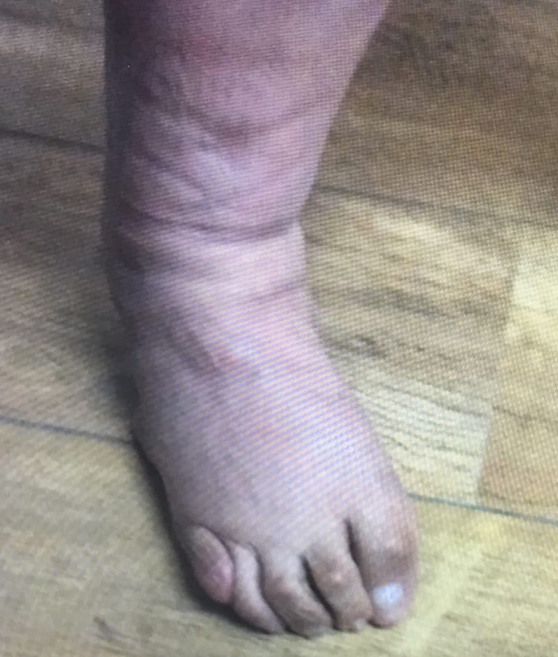 דיפורמציות בכפות הרגליים