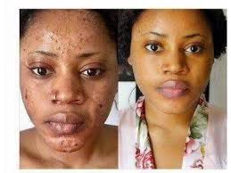 SCAR REMOVAL CREAM-TATTOO REMOVAL GEL AND DARK SPOTS (+27635694687)