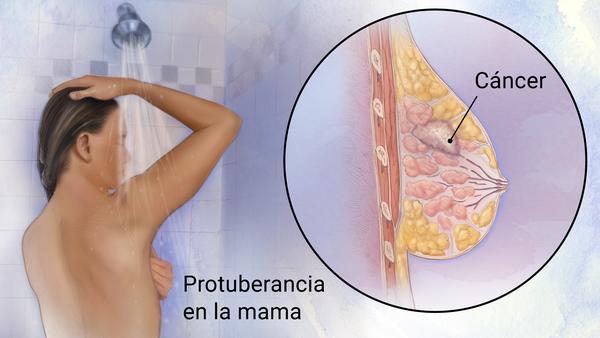 Cáncer de mamas: