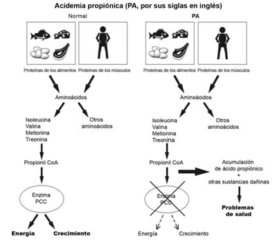 Acidemia propiónica image
