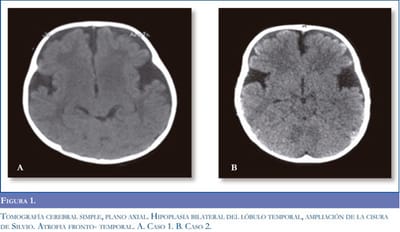 Aciduria glutárica tipo I image