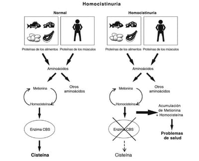 Homocistinuria image