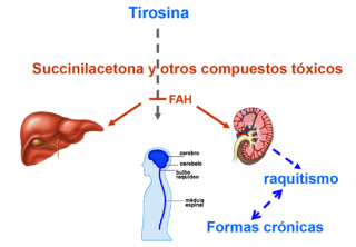Tirosinemia tipo 1 image