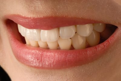 Gums Receding image