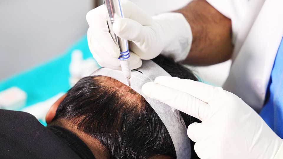 Common Misconceptions about Scalp Micropigmentation