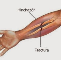 FRACTURA CERRADA