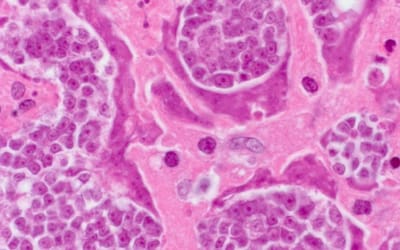 STATISTICS How many new cancer cases are recorded in Romania in 2018