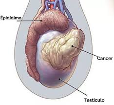 Experto en el cáncer de vías Urinarias