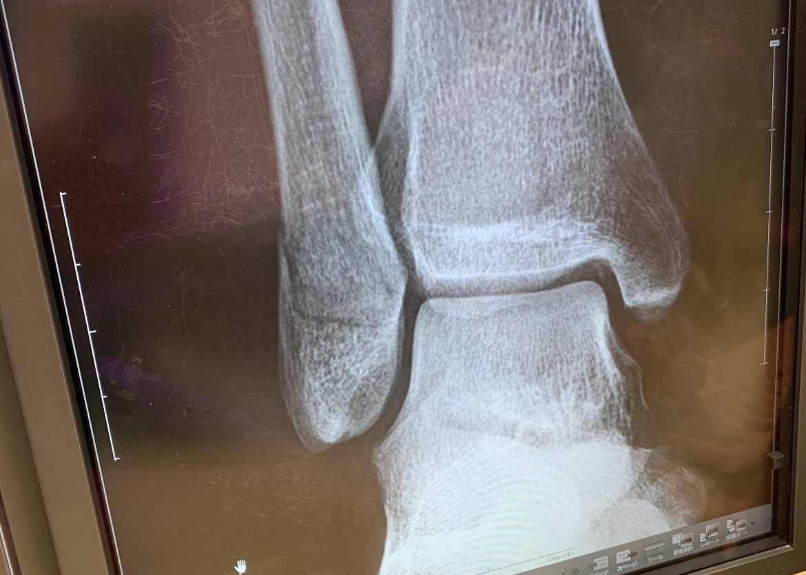 2022,4,26 腓骨下端骨折 １ヶ月半後にはどうなってる？