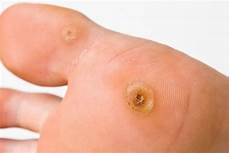 Verruca Treatment