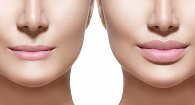 LIP augmentation image