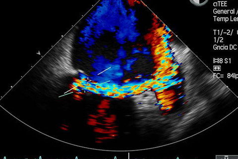 ECOCARDIOGRAMA DOPPLER COLOR