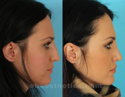 RHINOPLASTY image