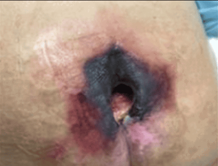 Kennedy Ulcers: Understanding, Identification, Care, And Significance In The End-Of-Life