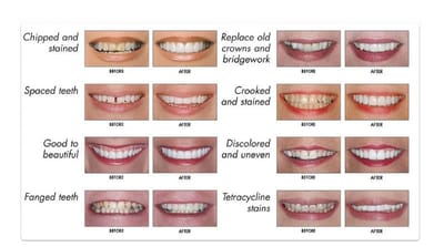 Veneers in Upper East Side image