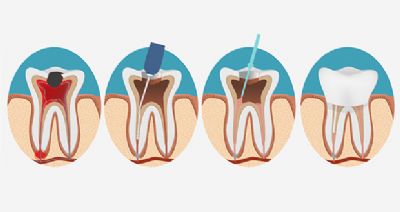 Root Canal In Upper East Side image