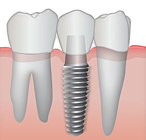 Dental Implants