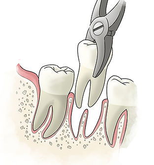 Tooth Extraction