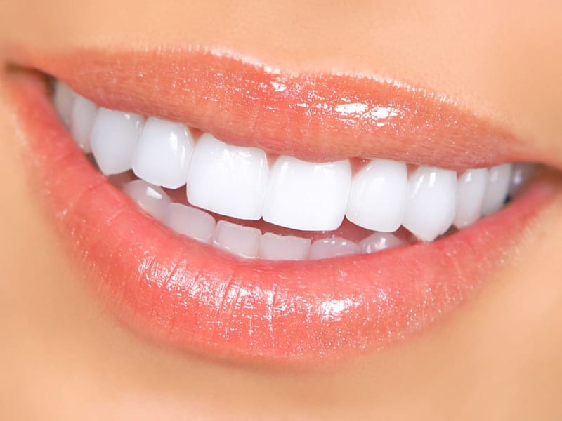 Teeth Whitening