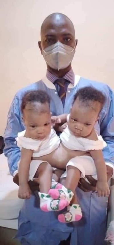 Conjoined Twins Successfully Separated
