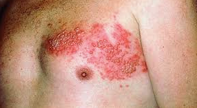 Shingles, what is it and how to treat