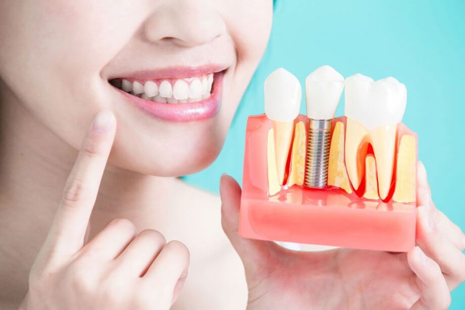 4 Advantages of Dental Implants near Me