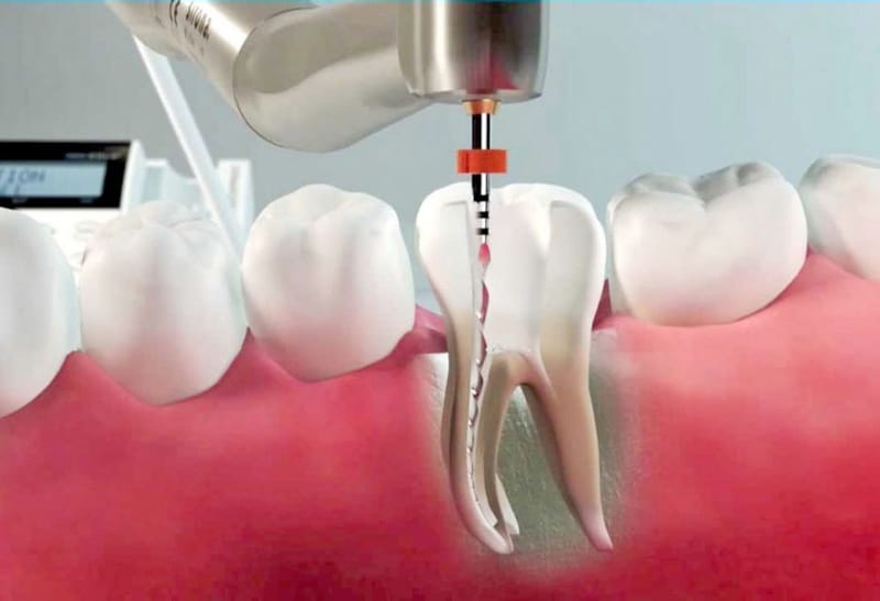 ENDODONZIA