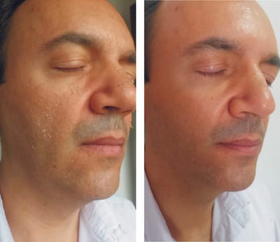 Peeling 4D - com fotos antes e depois