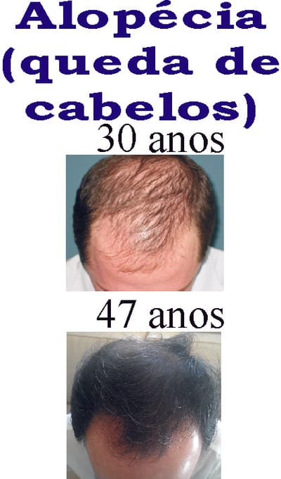 Alopecia - antes e depois