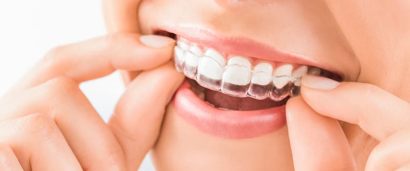 What Are the Benefits Of Using Dental Retainers?
