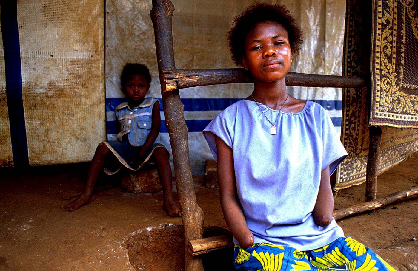 Amputee victim, Sierra Leone, 2000.