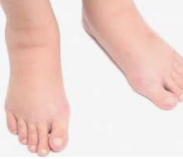 Eviter la rétention d'eau