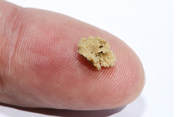 Sỏi thận 6mm là gì?