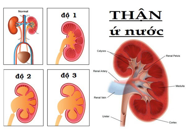 Dấu hiệu thận ứ nước là gì?