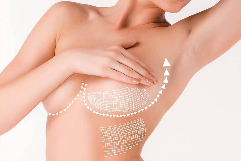 Mammoplasty