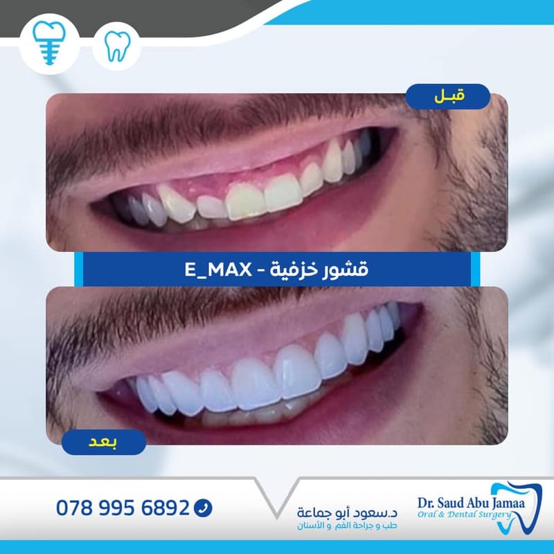 القشور الخزفيه